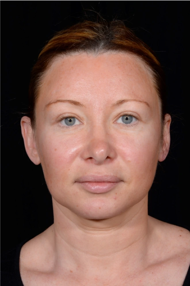 Facelift-and-Facial-Fat-Grafting-Case--1679 | Before Face 1