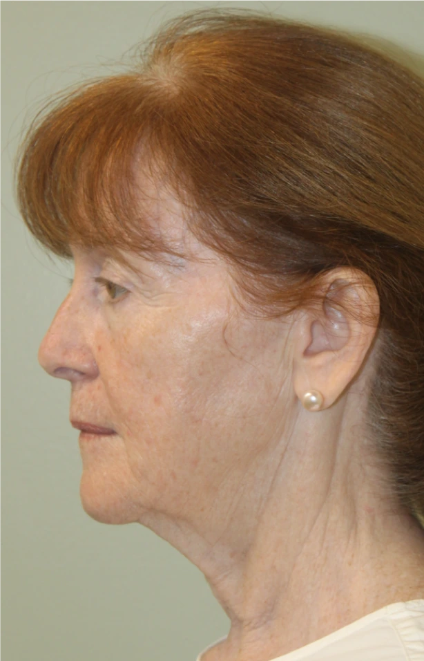Facelift-Case--1951 | Before Facelift 2