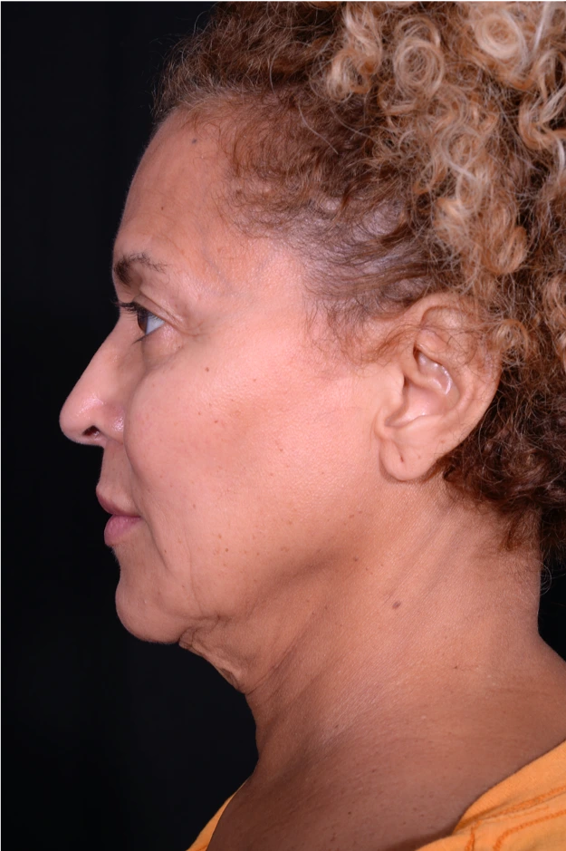 Face-and-Neck-Lift-Case--3772 | Before Facelift 2