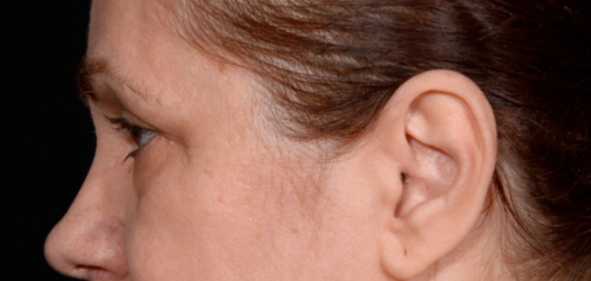 Quad-Blepharoplasty-Case--1851 | Before Dr. Arjun Kanuri 2