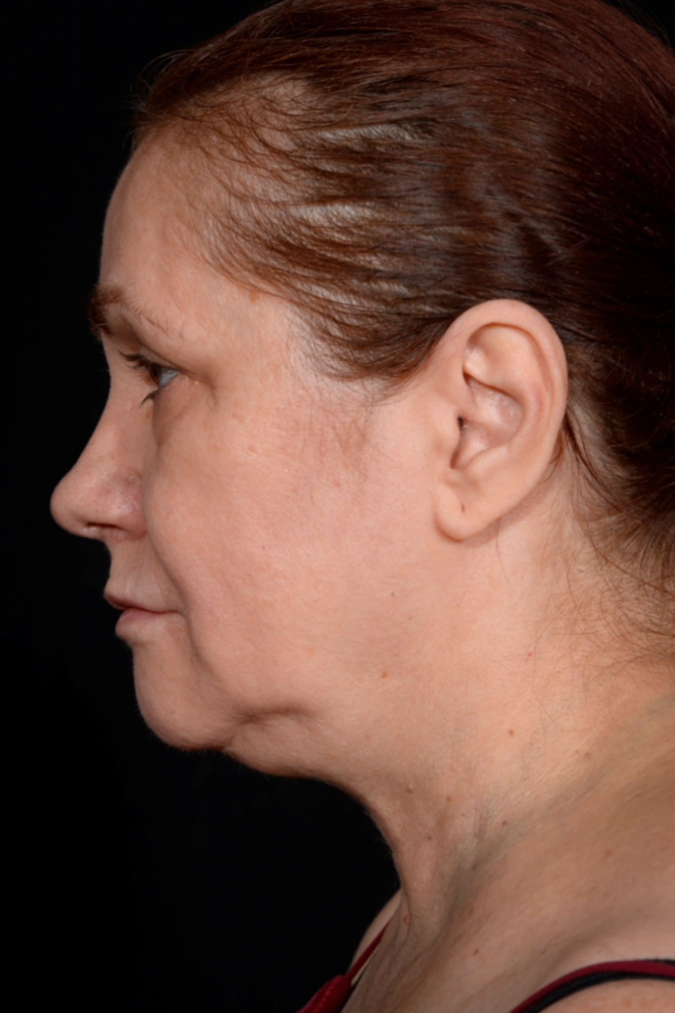 Necklift-Case--1496 | Before Dr. Arjun Kanuri 1
