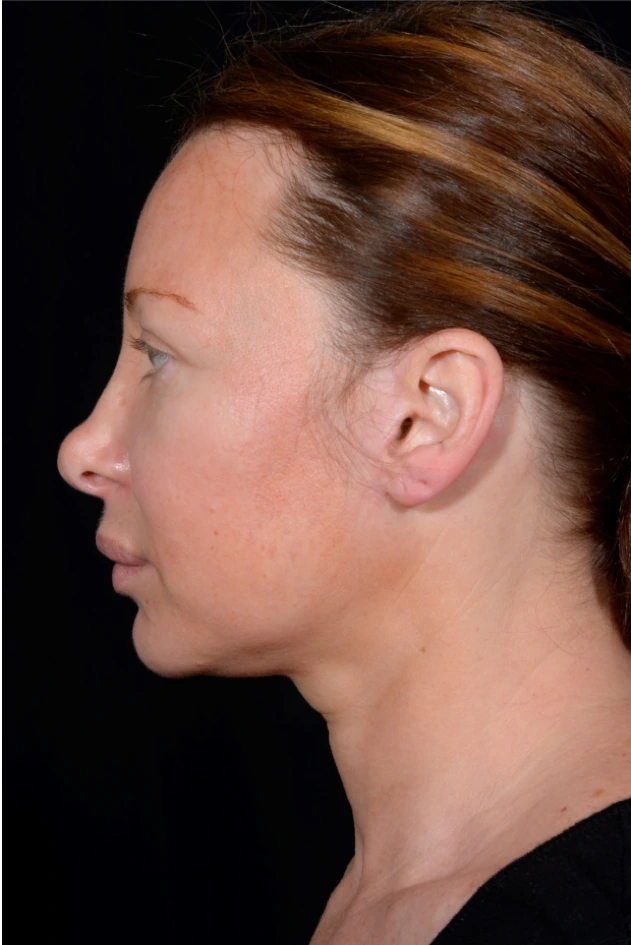 Facelift-and-Facial-Fat-Grafting-Case--1679 | Before Face 2