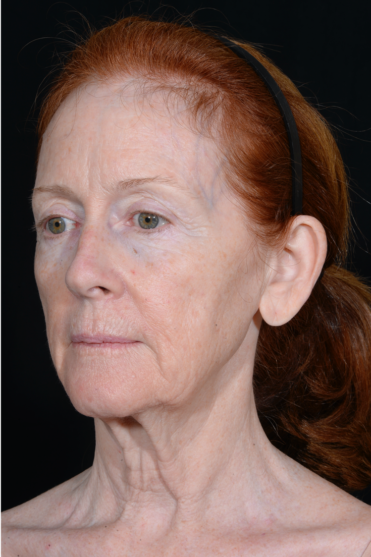 Facelift-Case--1951 | Before Facelift 3