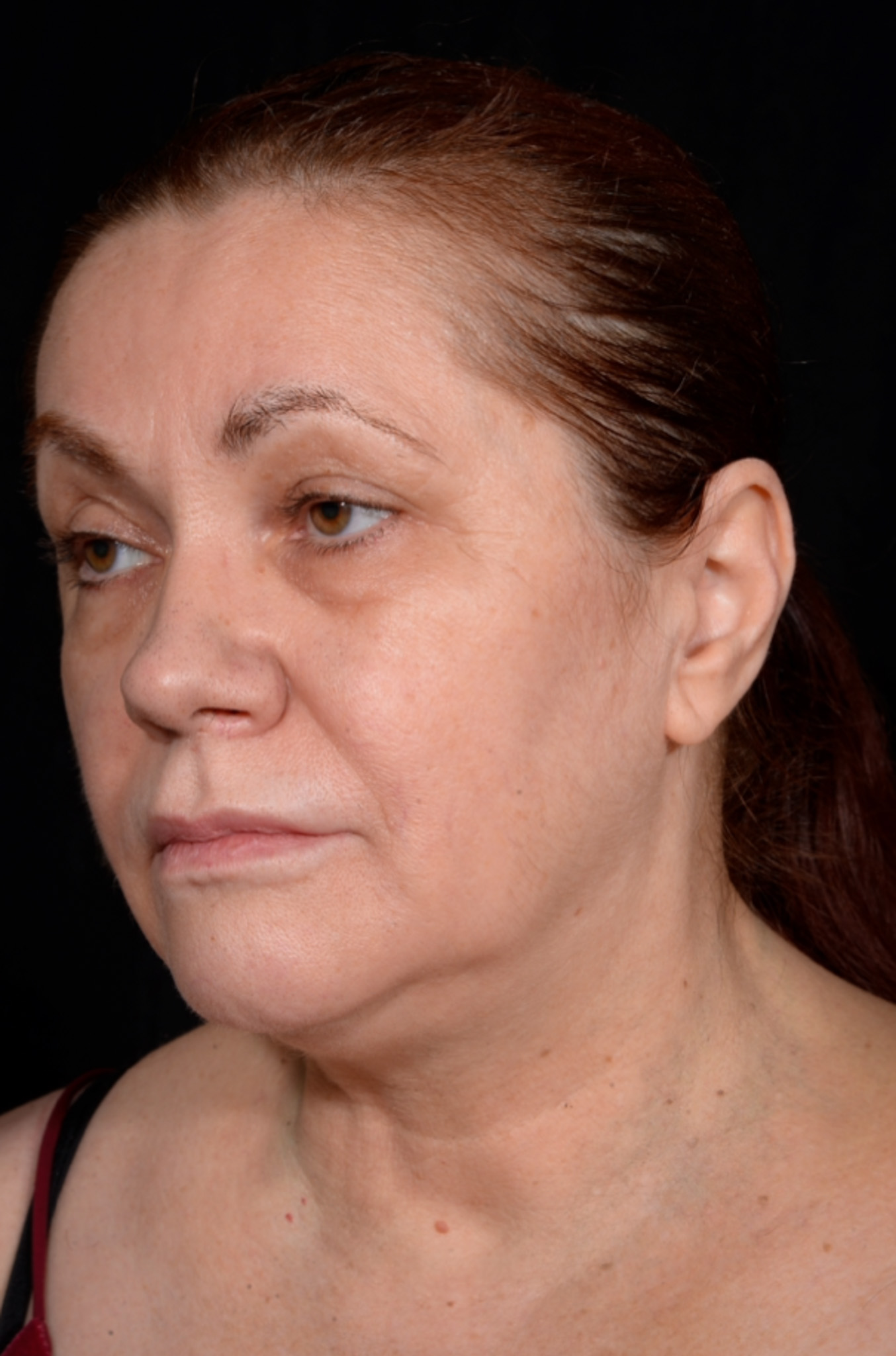 Necklift-Case--1496 | Before Neck Lift 4