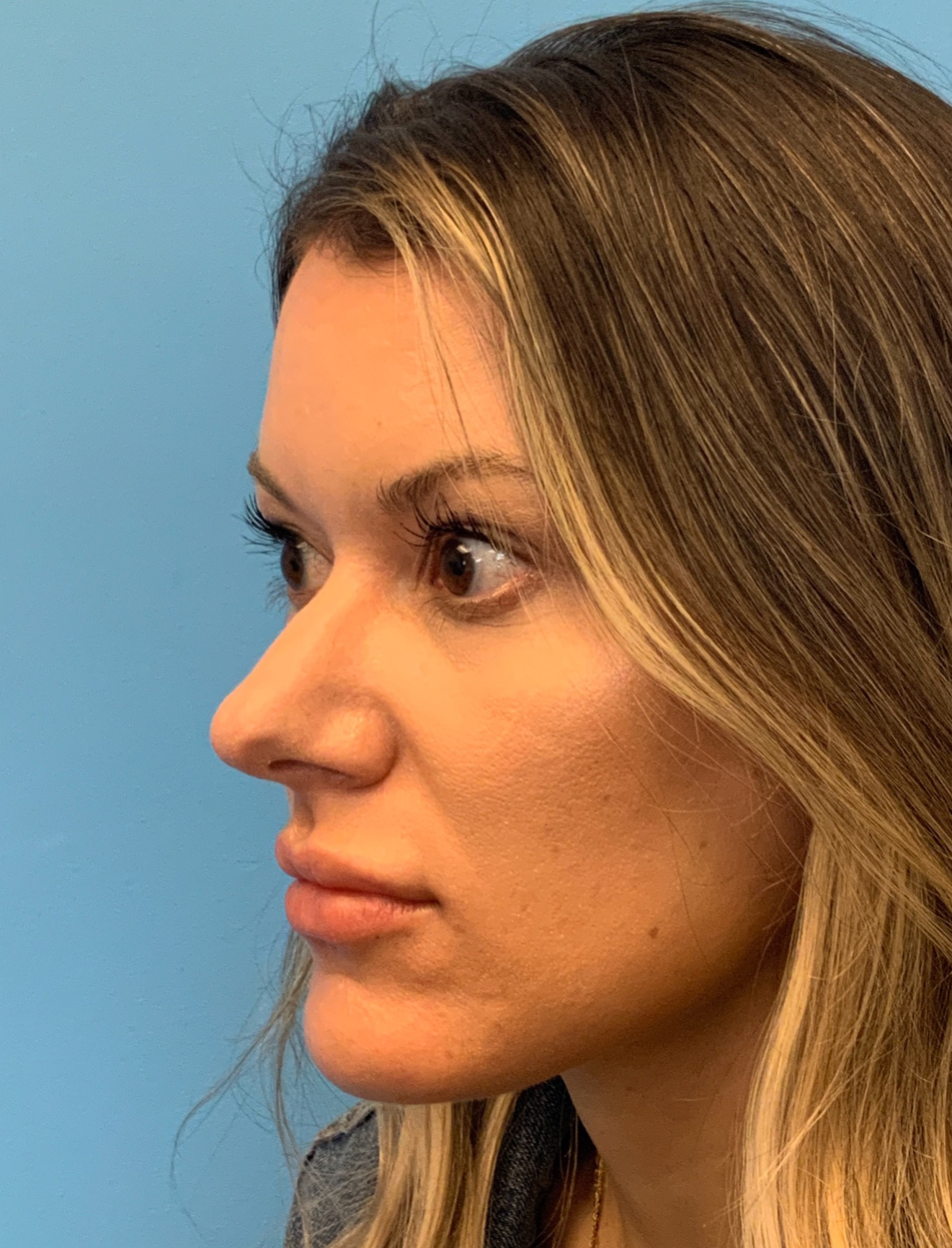 Rhinoplasty-Case--4972 | Before Rhinoplasty 5
