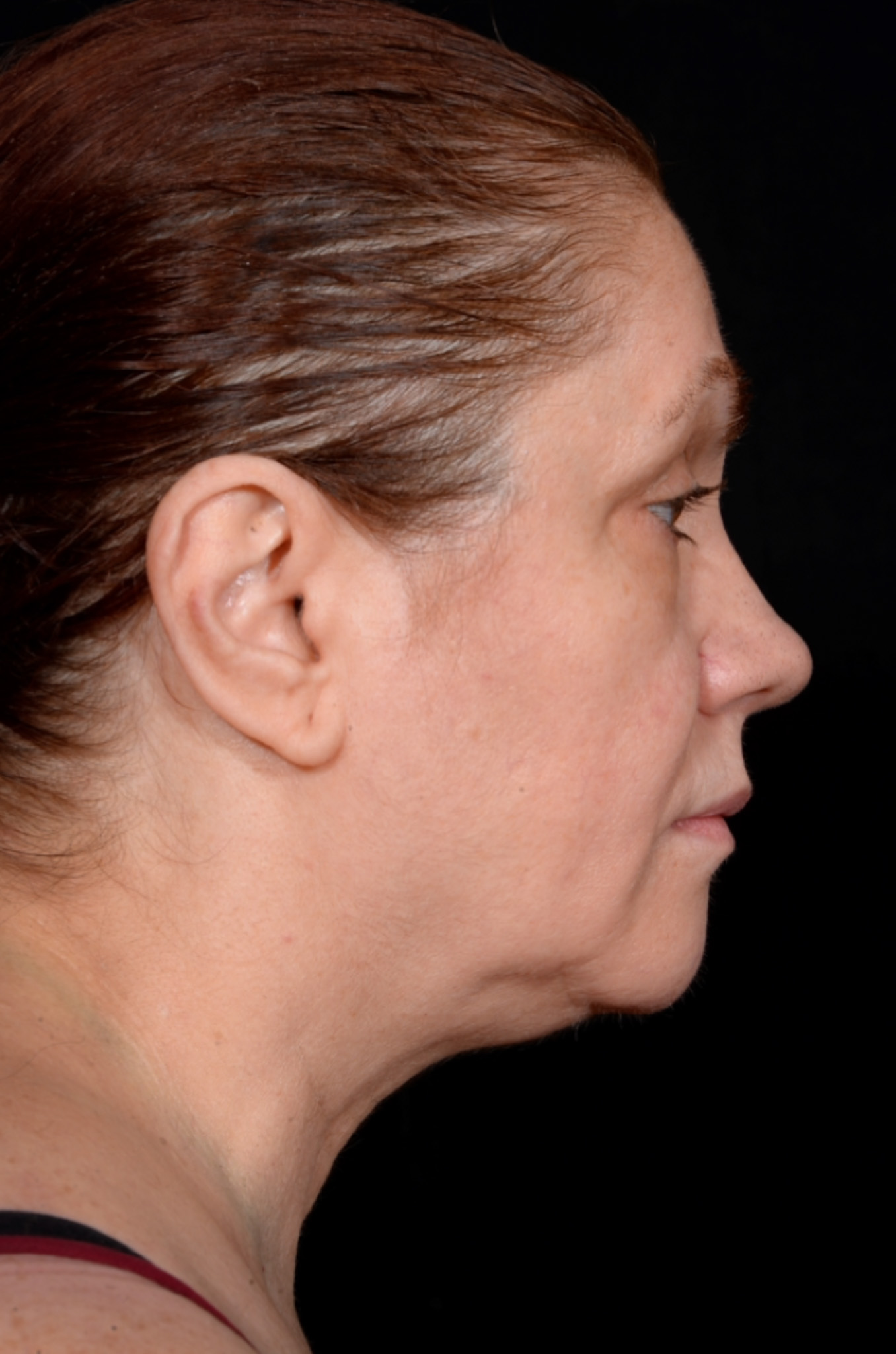 Necklift-Case--1496 | Before Dr. Arjun Kanuri 2