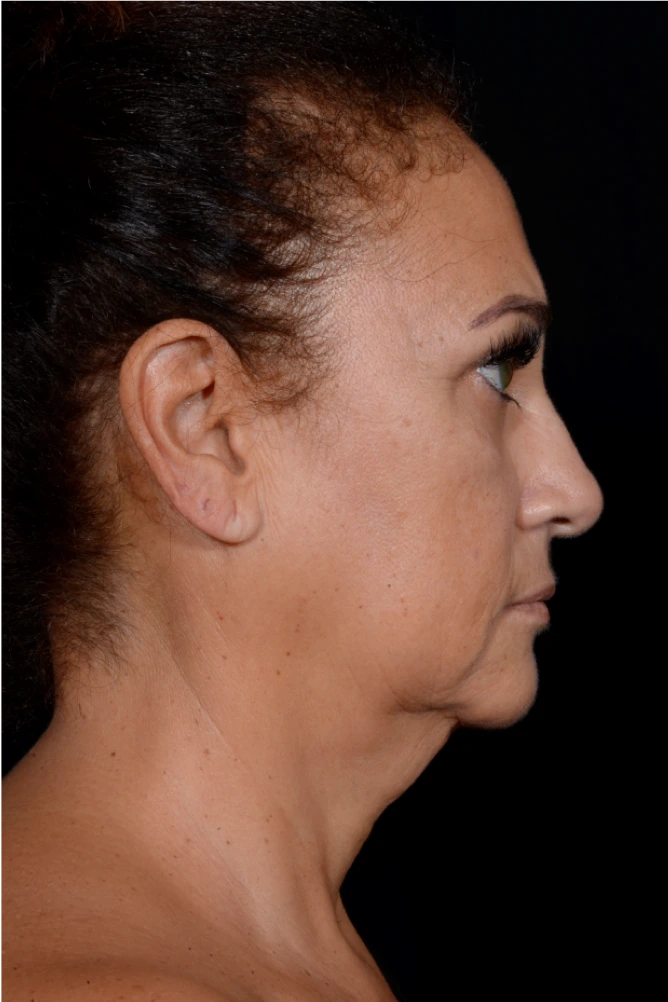Necklift-Case--4869 | Before Neck Lift 2