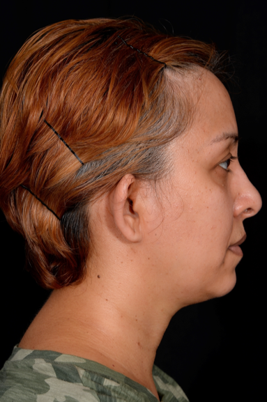 Otoplasty-Case--4655 | Before Dr. Arjun Kanuri 2