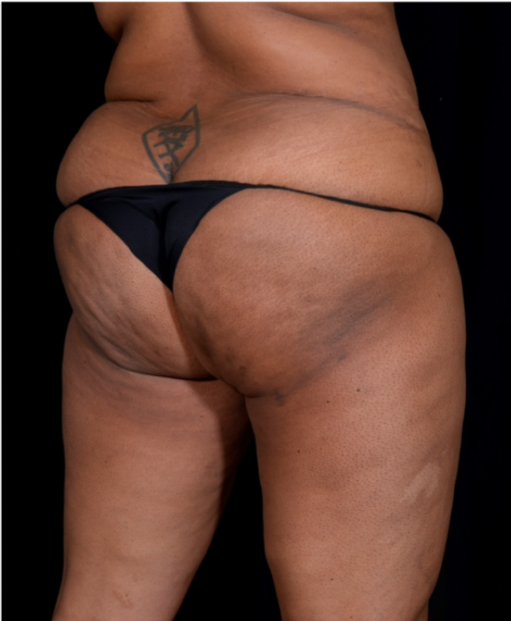 Brazilian-Butt-Lift-Case--7979 | Before Dr. Arjun Kanuri 2