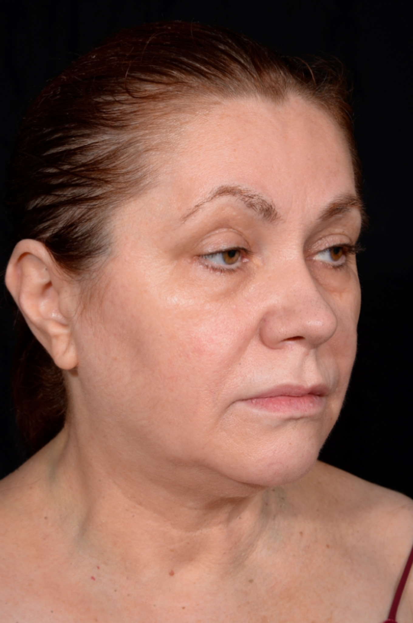 Necklift-Case--1496 | Before Neck Lift 3