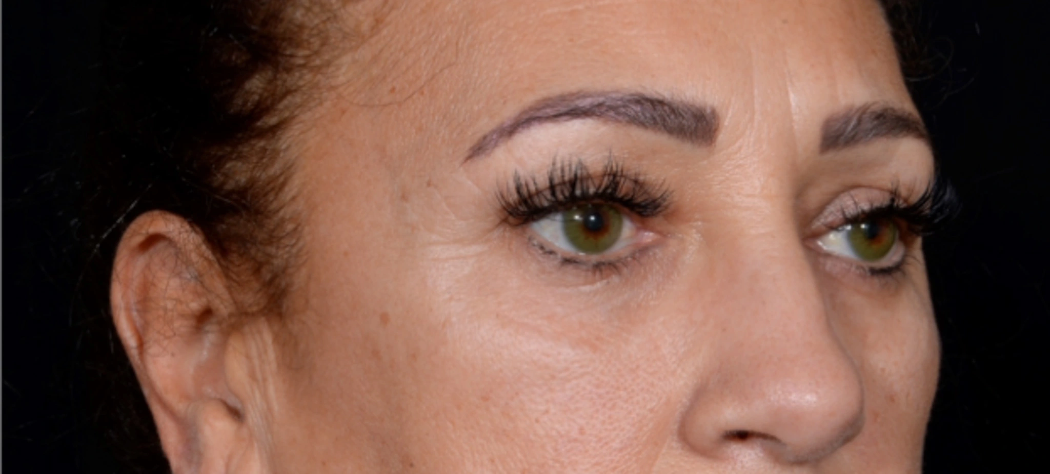 Brow-Lift-Case--6540 | Before Brow Lift 3