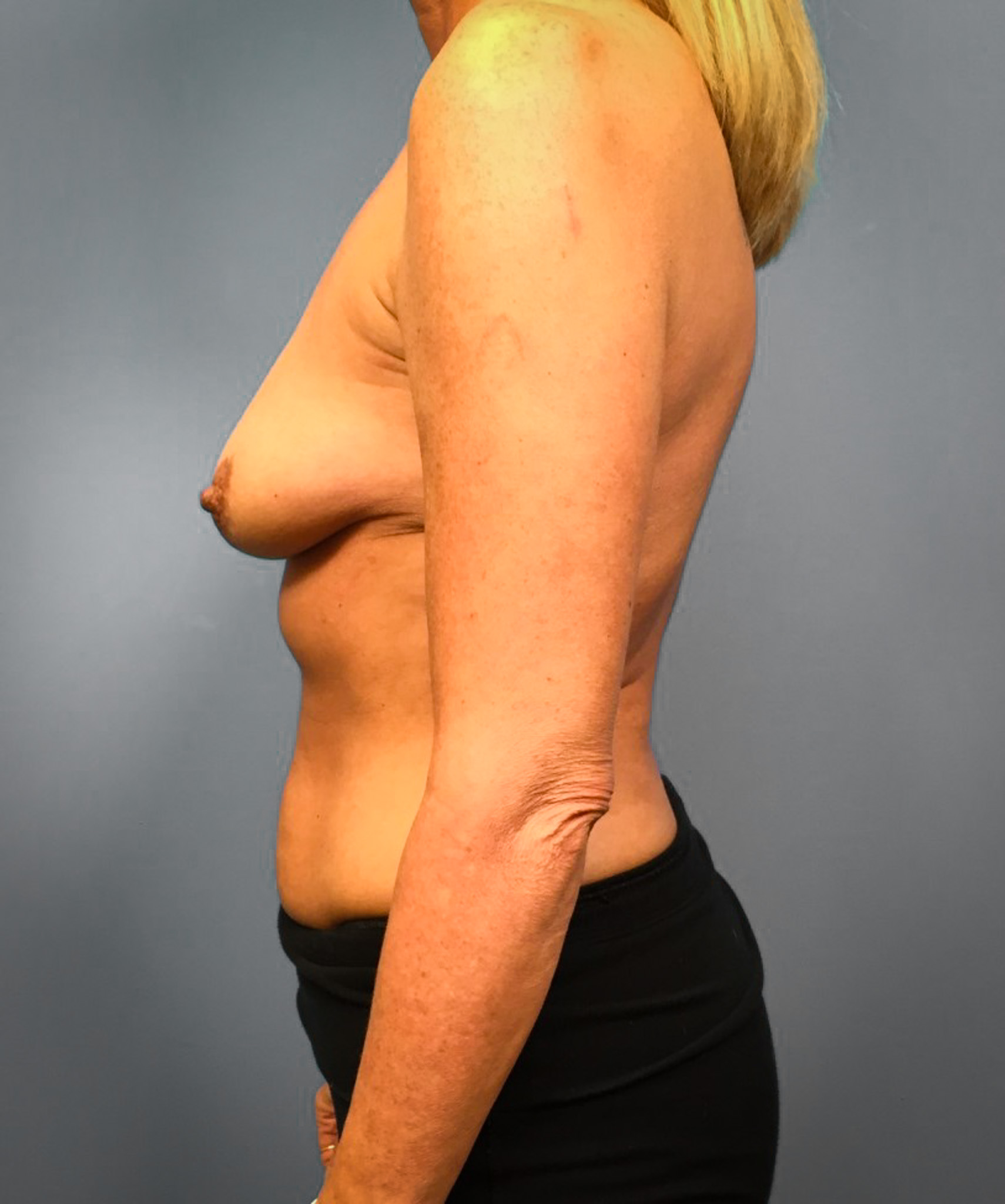 Before Breast Augmentation (Side)