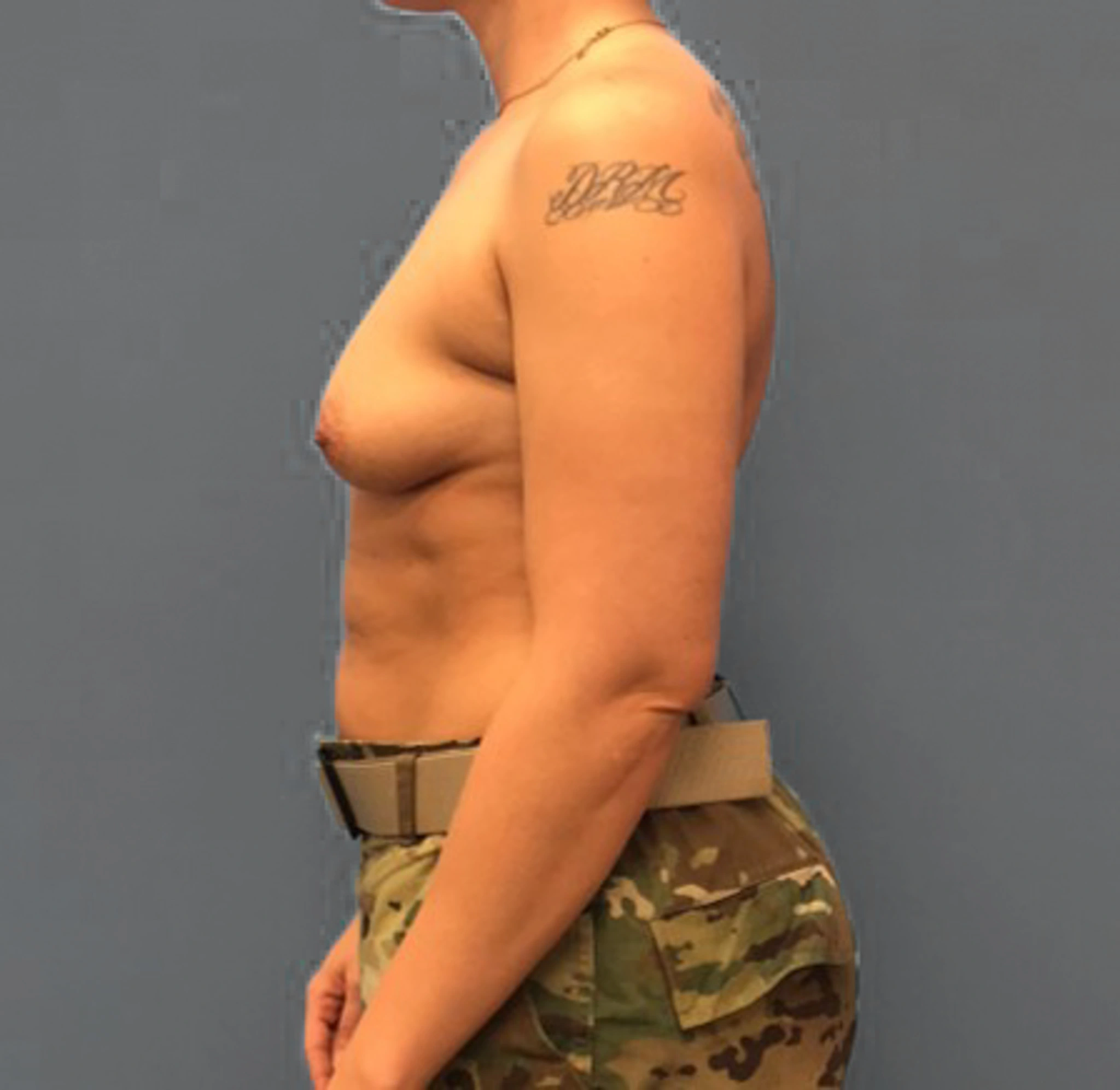 Before Breast Augmentation (Side)