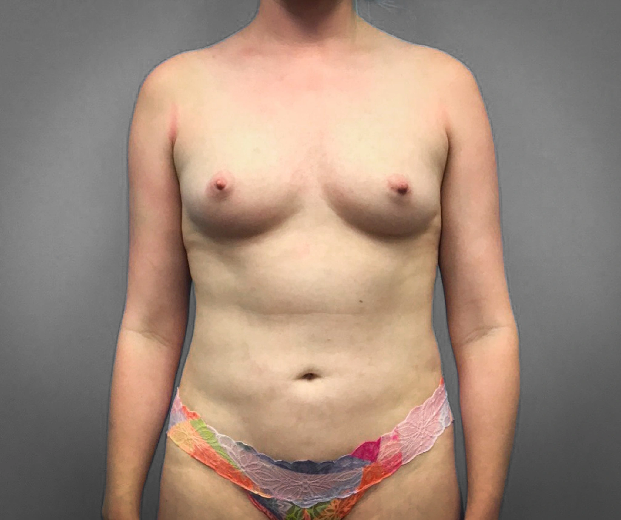 Before Breast Augmentation (Front)