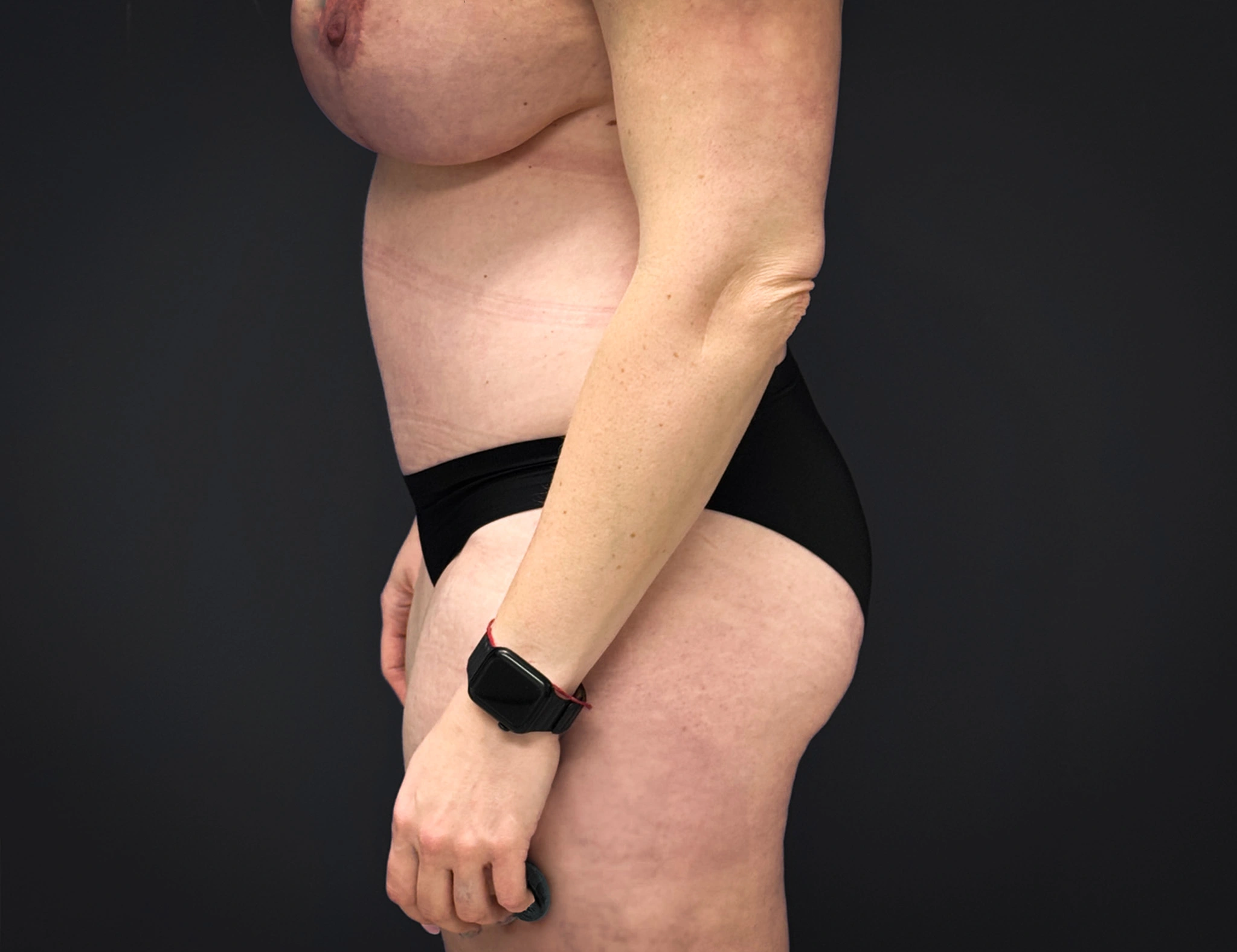 Abdominoplasty-Liposuction-Flanks-Case--6546 | After Body 2
