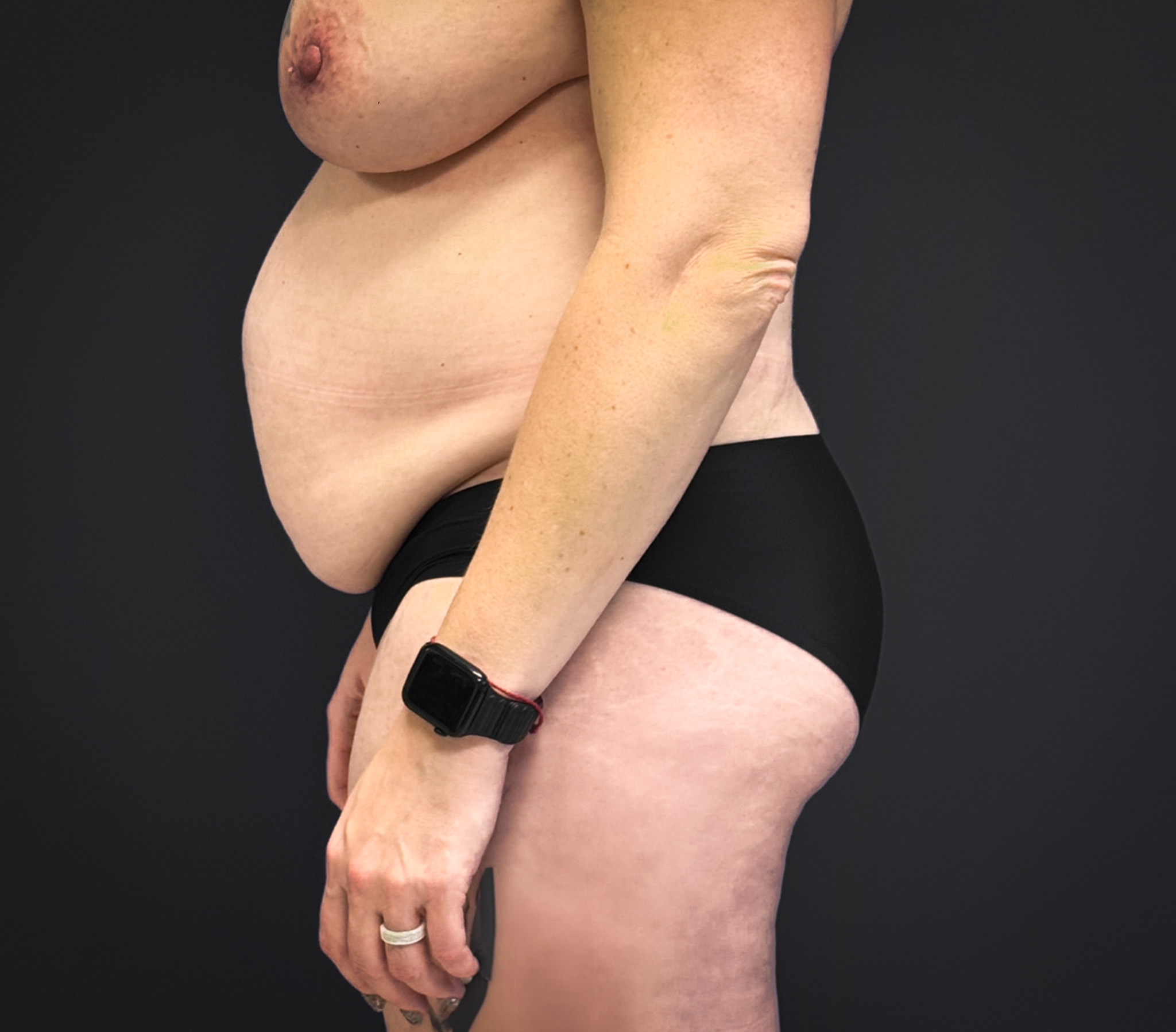 Abdominoplasty-Liposuction-Flanks-Case--6546 | Before Body 2