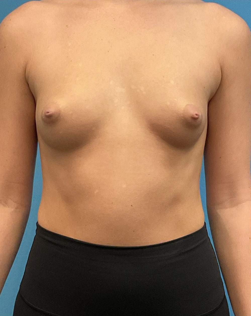Breast-Augmentation-Case--28179 | Before Dr. Arjun Kanuri 1