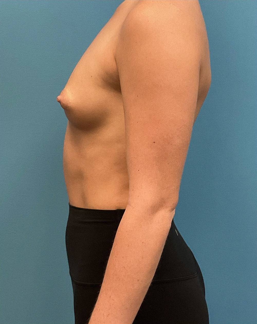 Breast-Augmentation-Case--28179 | Before Breast Augmentation 3