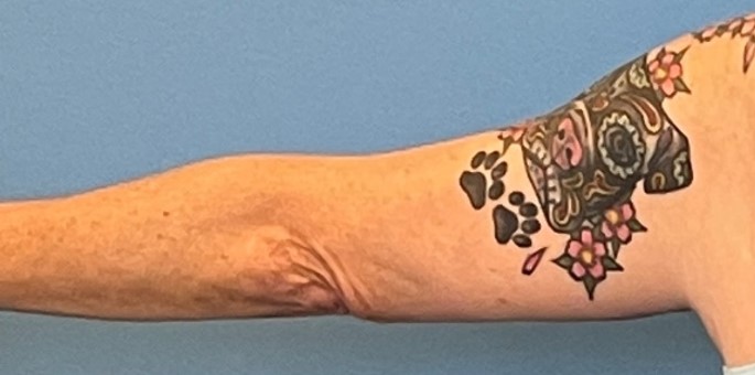 After photo of patient undergoing an arm lift