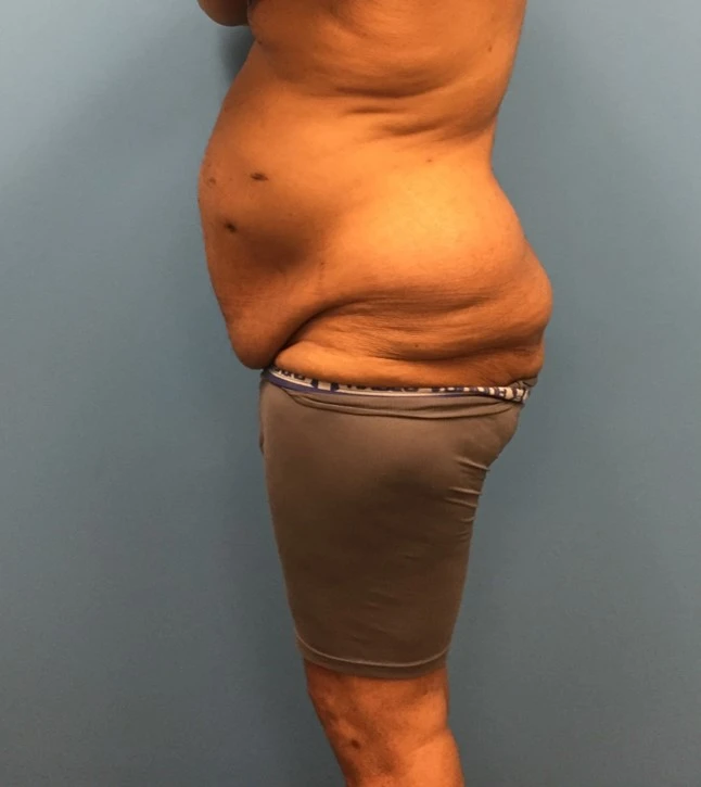 Side Profile of patient before undergoing a body lift procedure