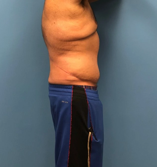 Side profile of patient after undergoing a body lift procedure