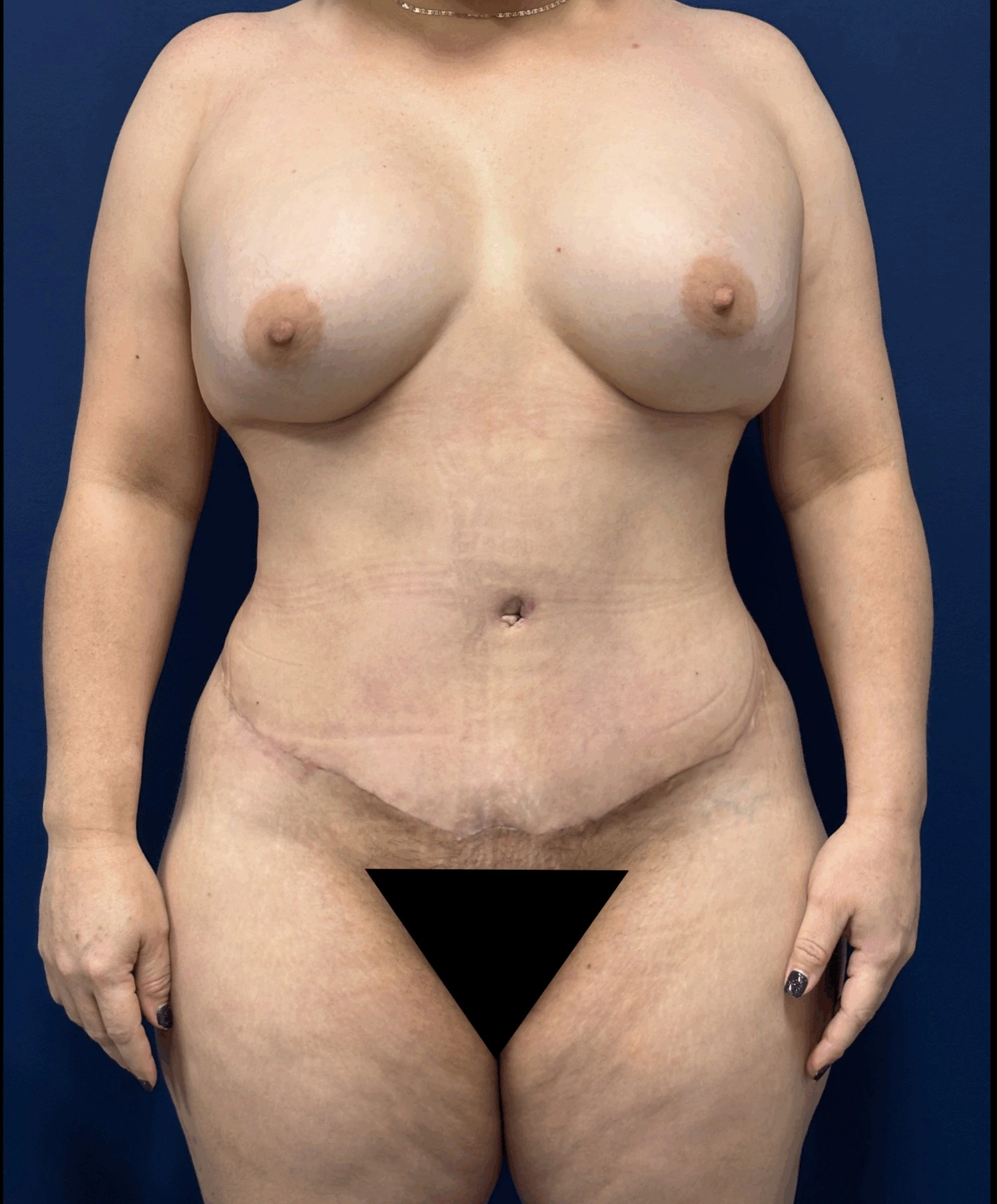 Abdominoplasty-Case--1259 | After Body 1