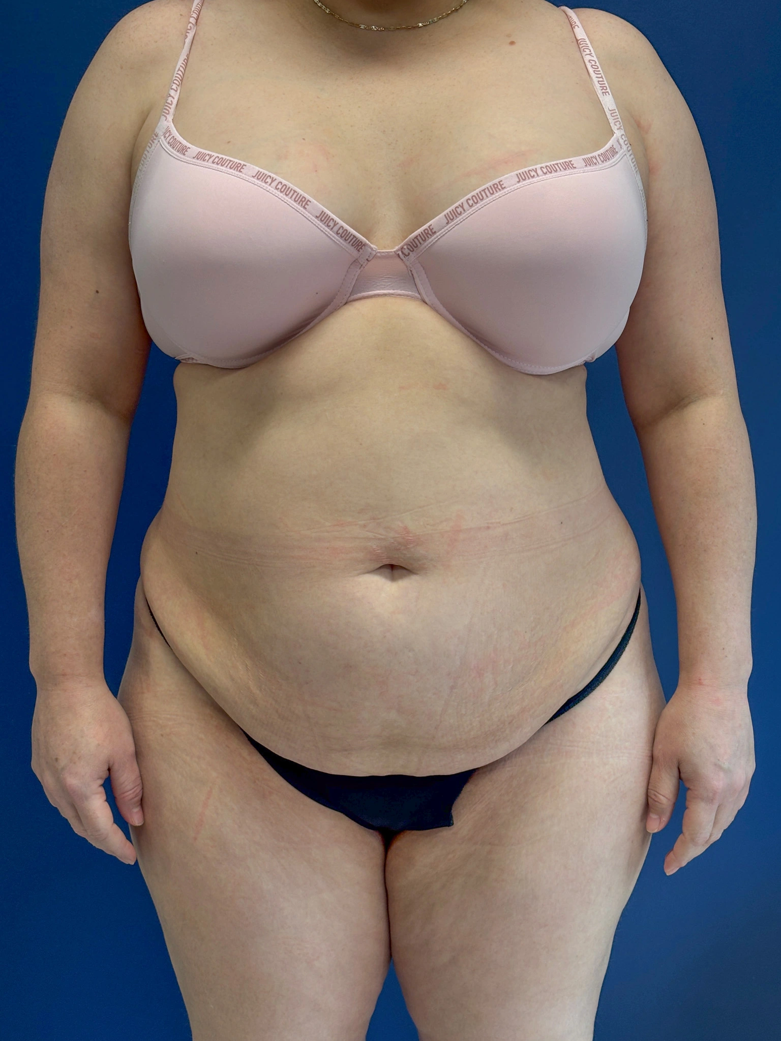 Abdominoplasty-Case--1259 | Before Body 1