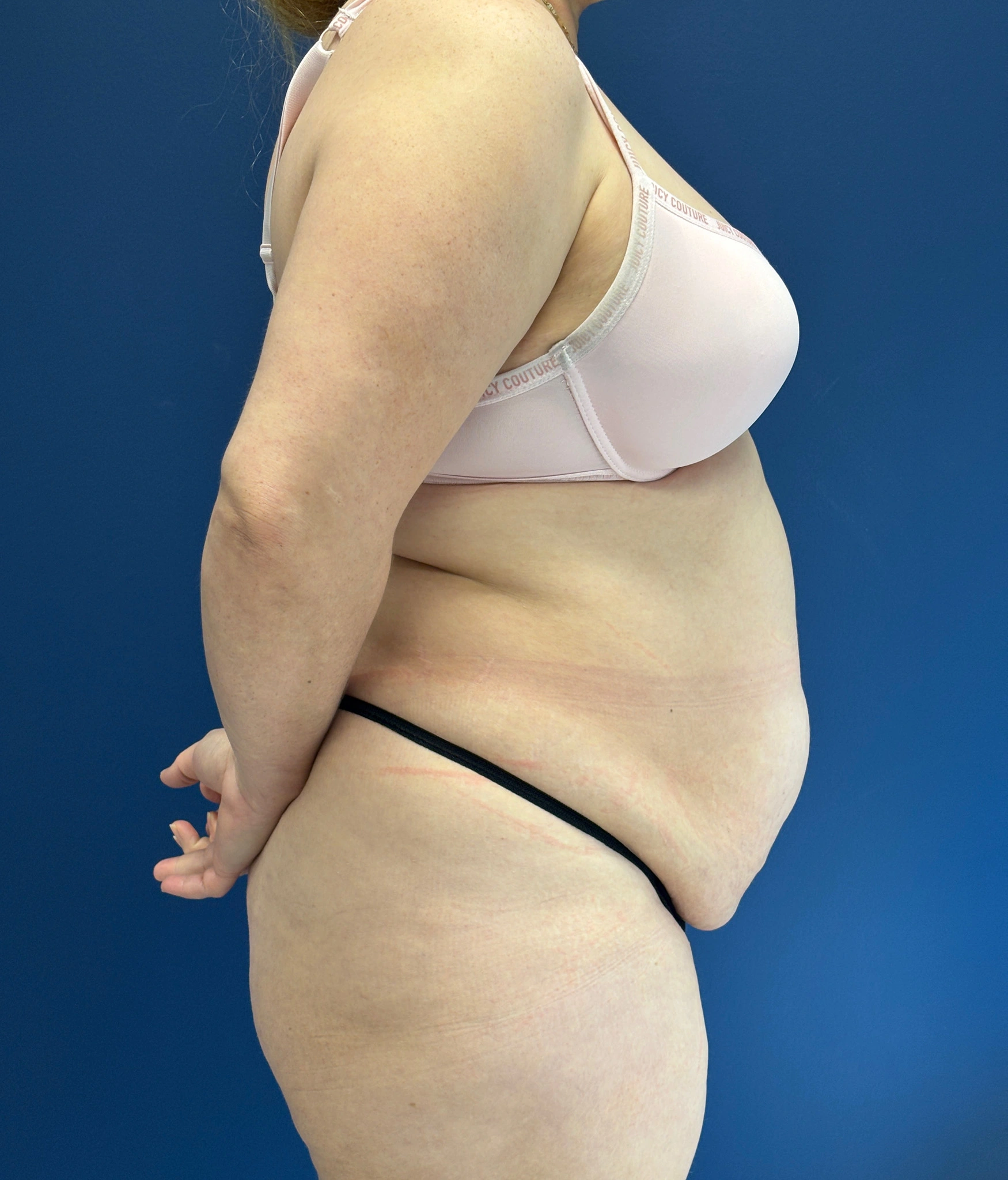 Abdominoplasty-Case--1259 | Before Body 2