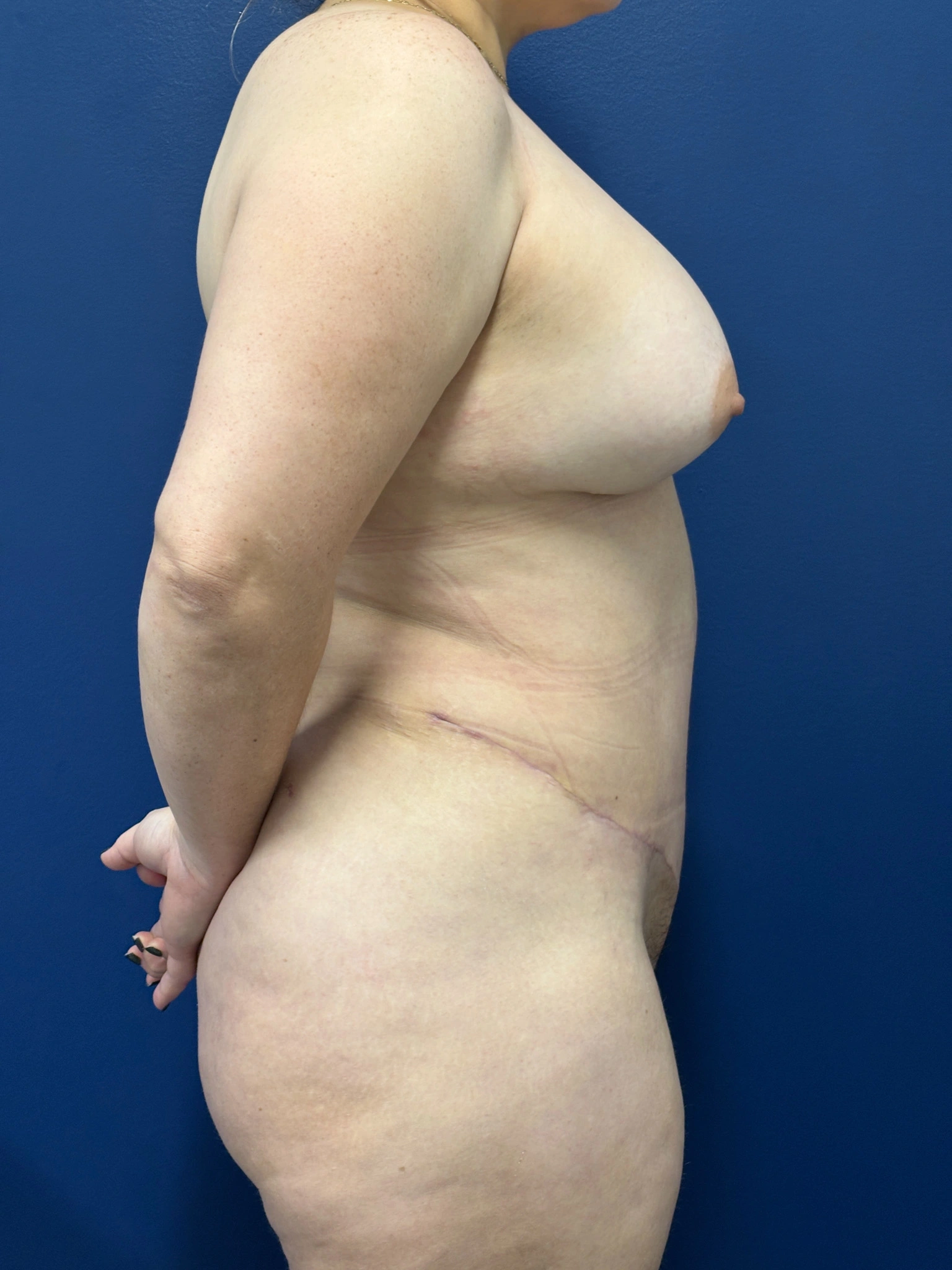 Abdominoplasty-Case--1259 | After Body 2