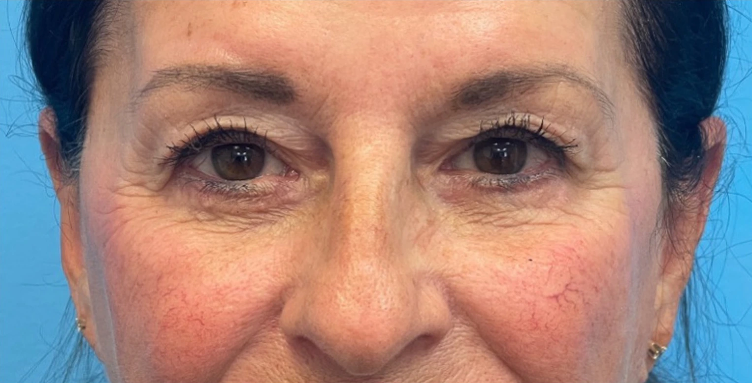 Lower-Blepharoplasty-Case--26440 | After Dr. Samir Rao 1
