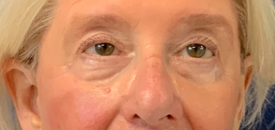 Blepharoplasty-Case--4349 | After Dr. Arjun Kanuri 1