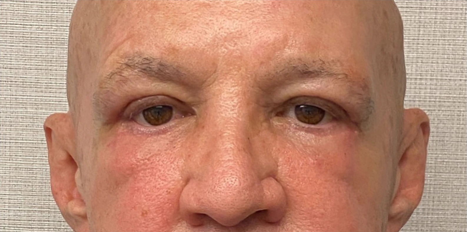 Blepharoplasty-Case--24169 | After Dr. Arjun Kanuri 1