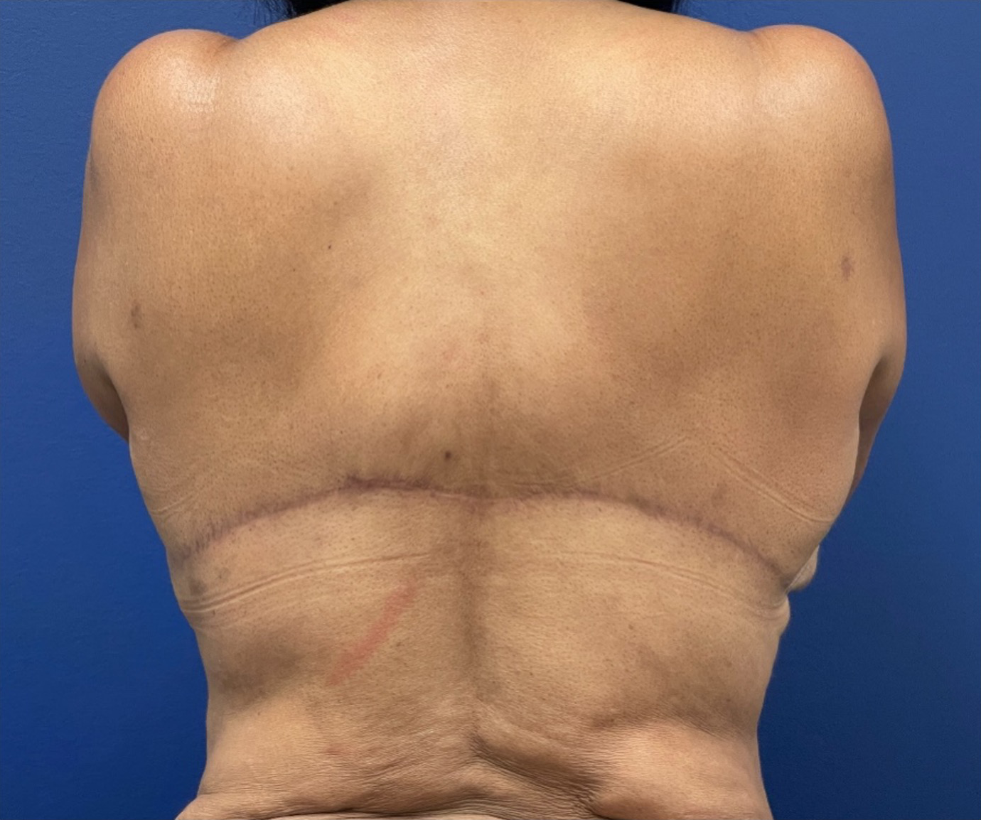 Body-Lift-Case--274 | After Body 1