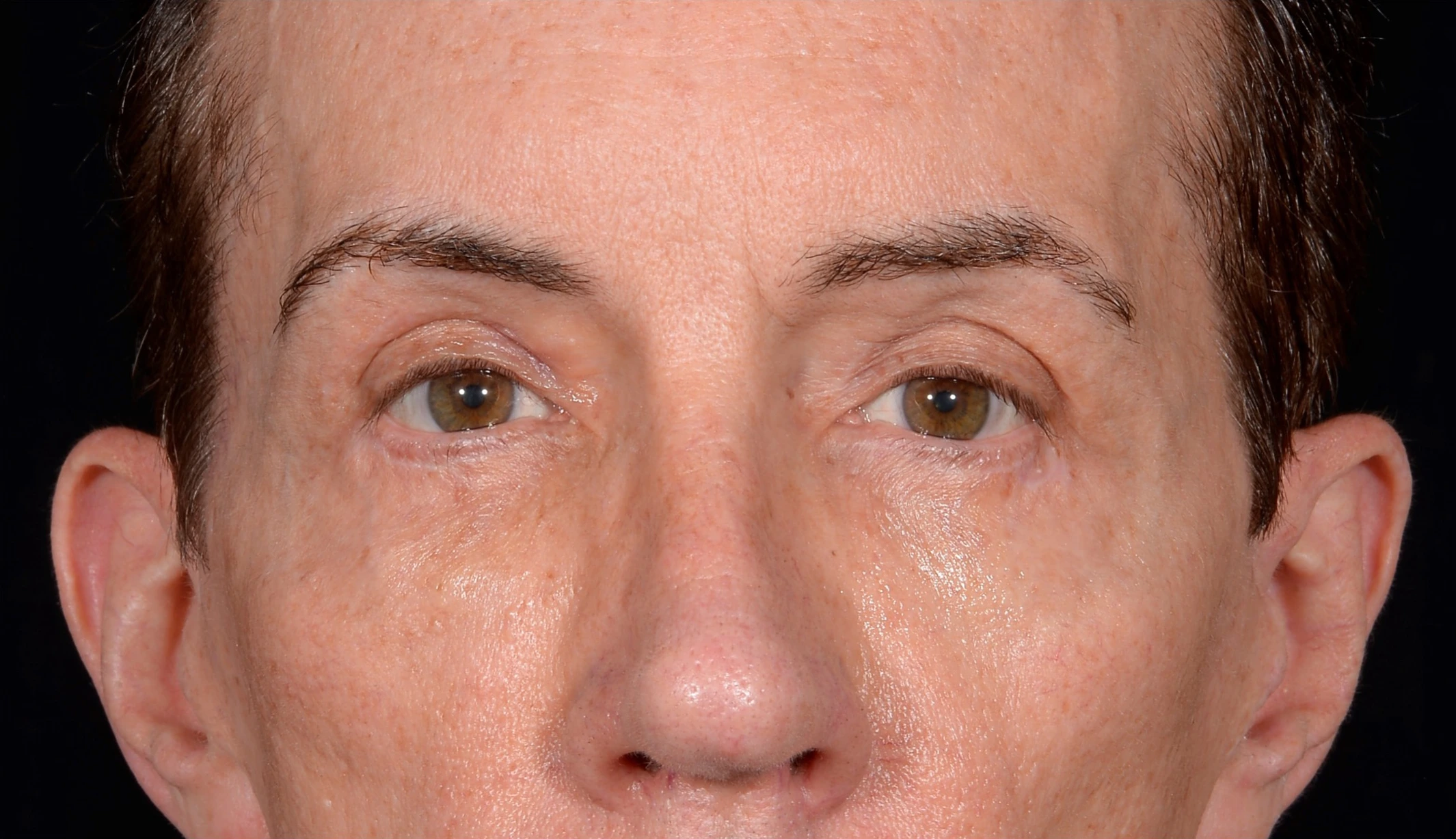 Quad-Blepharoplasty-Case--357 | After Face 2