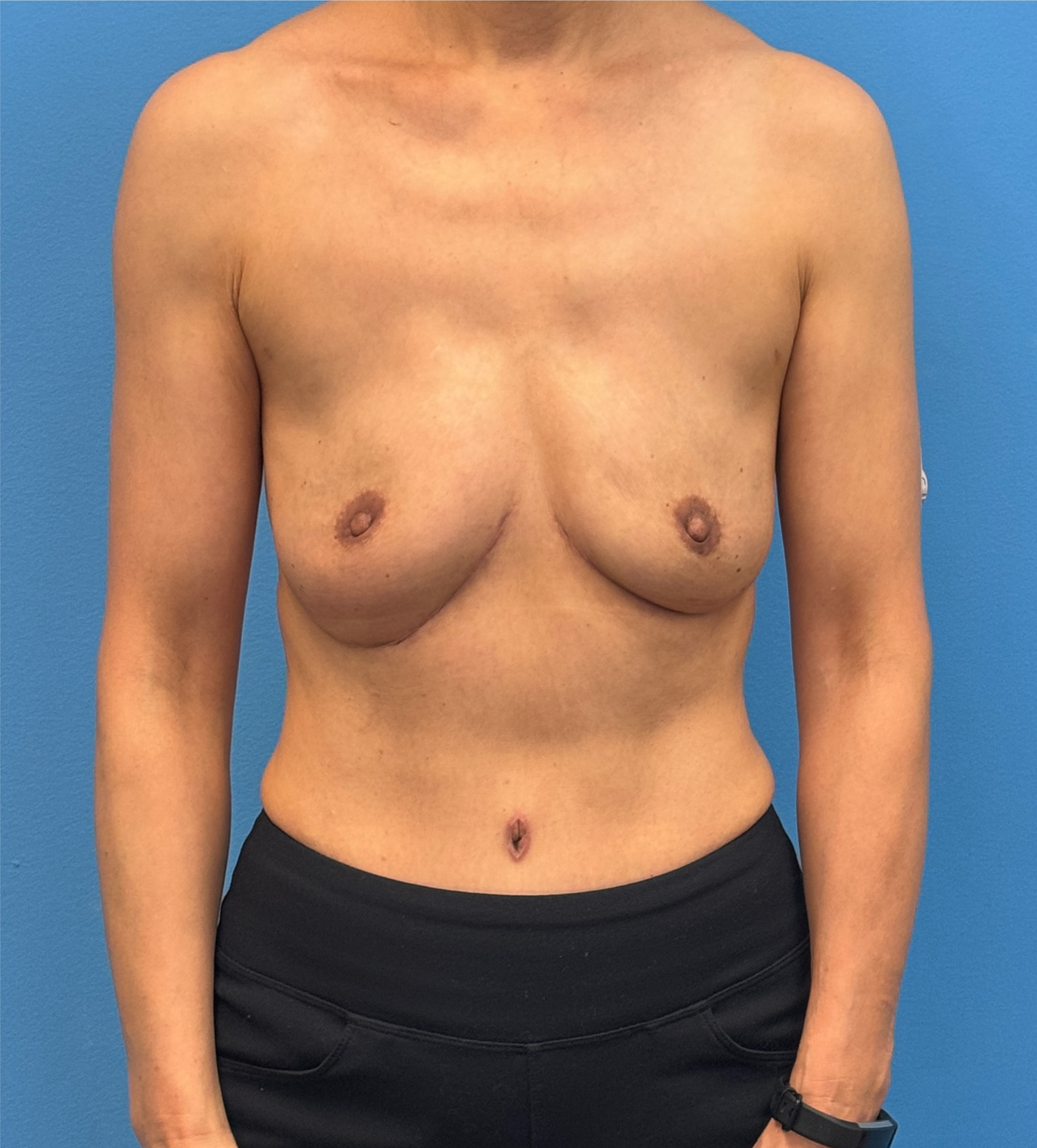 Diep-Flap-Procedure | After DIEP Flap 1