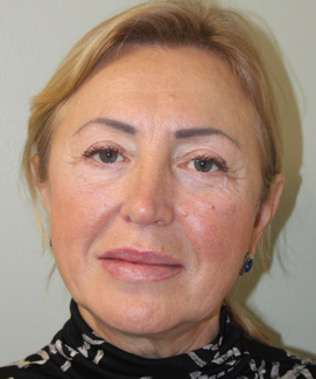 Facelift-Case--401 | After Dr. Arjun Kanuri 1