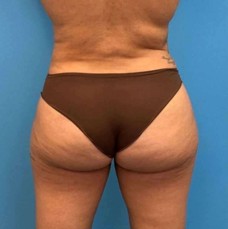 Case--25704 | After Body 2