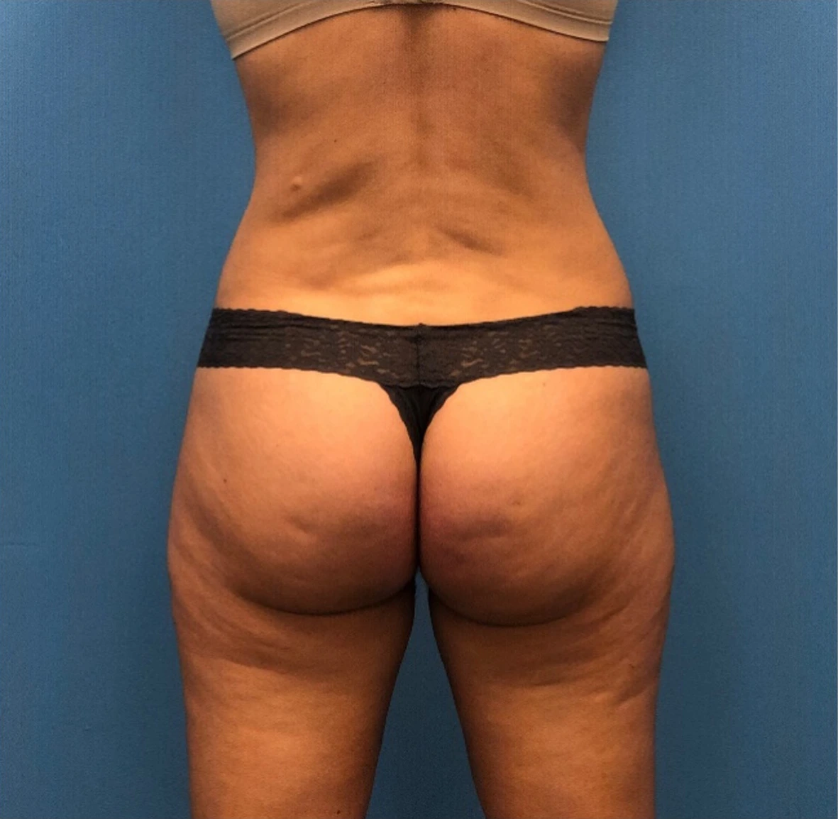 Lipo-360-Case--277 | After Liposuction 3