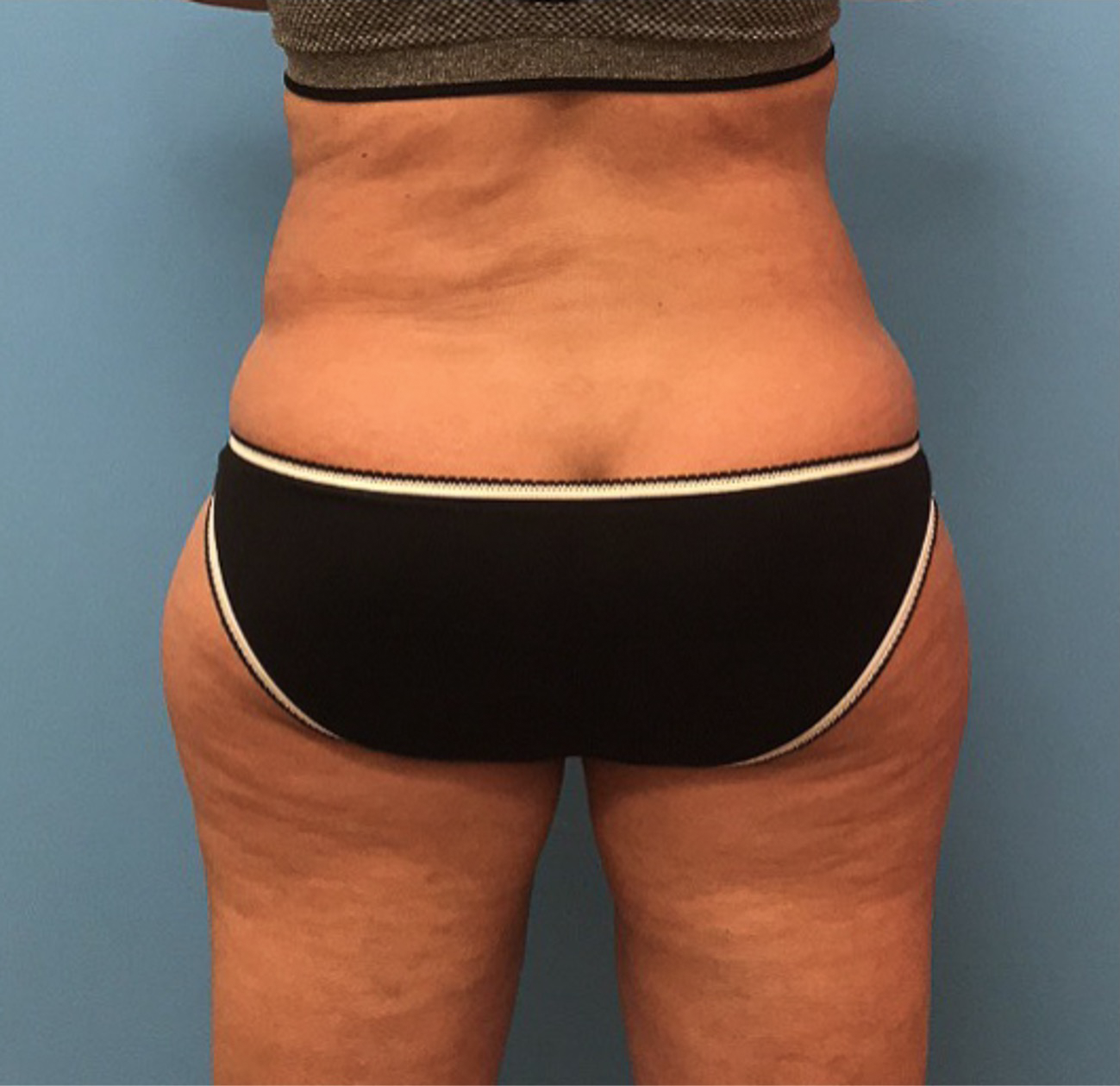 Liposuction-Case--72-1 | After Liposuction 3