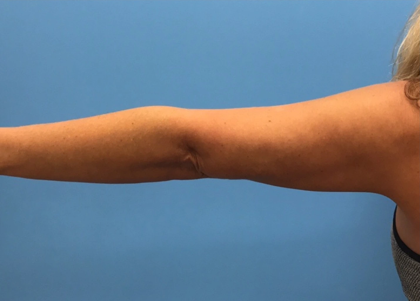 Case--280 | After Liposuction 3