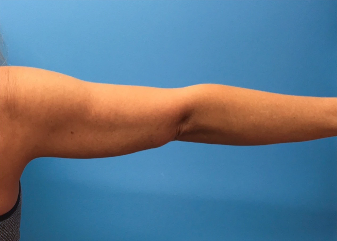 Case--280 | After Liposuction 4