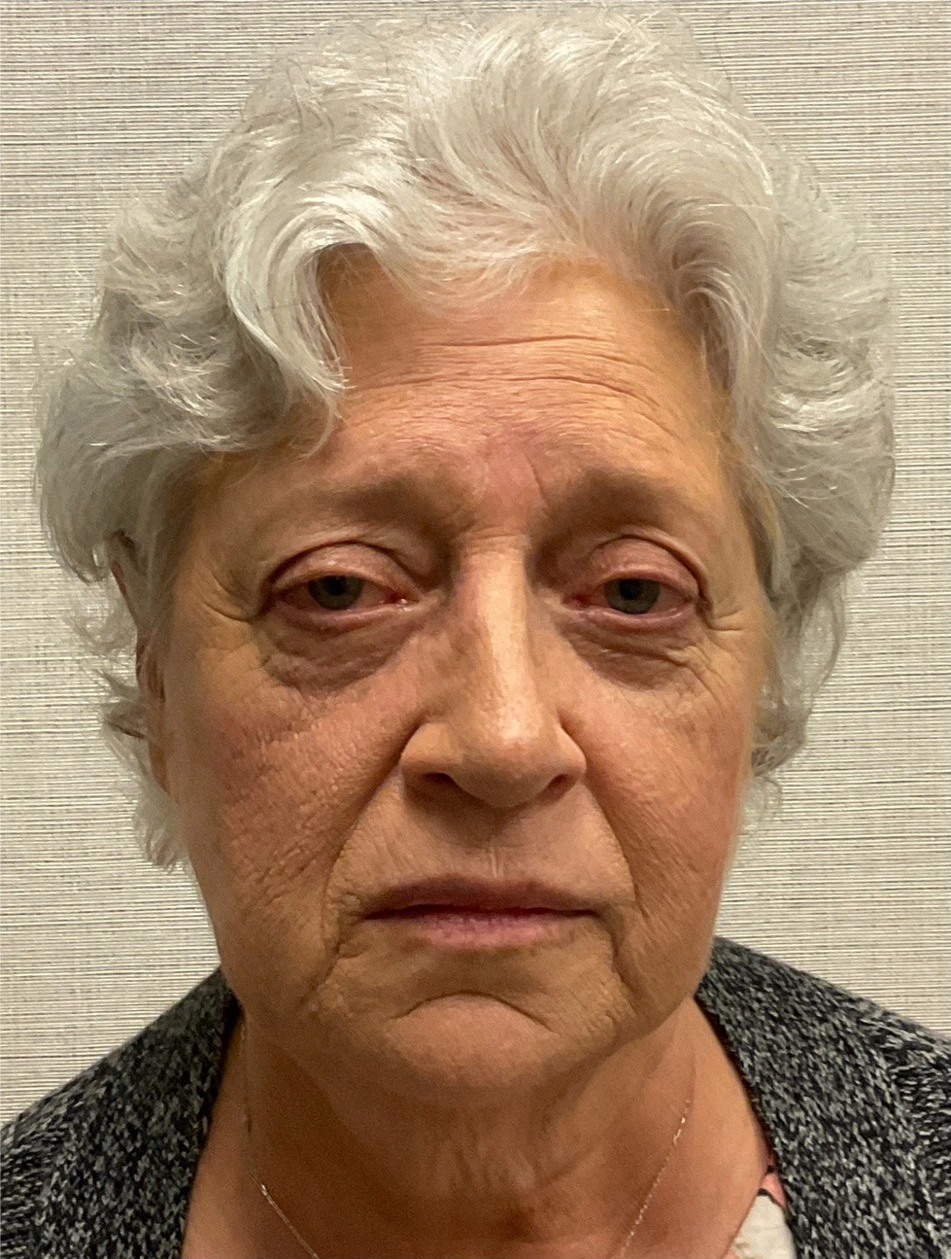 Rhinoplasty-Case--25467 | After Rhinoplasty 5