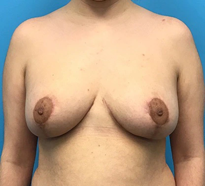 Breast-Reduction-Case--132 | After Breast Reduction 1