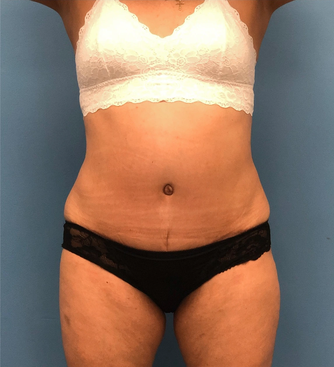 Case--14819 | After Body 1