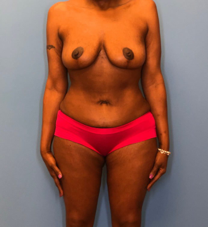 Mommy-Makeover-Case--13869 | After Body 1