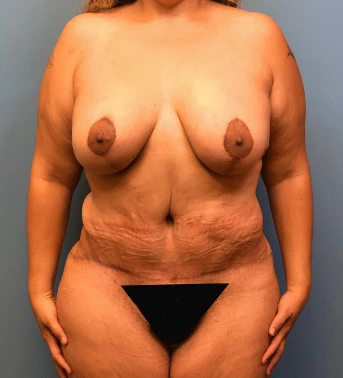Lipoabdominoplasty-Breast-Augmentation-Case--15133 | After Dr. Samir Rao 1