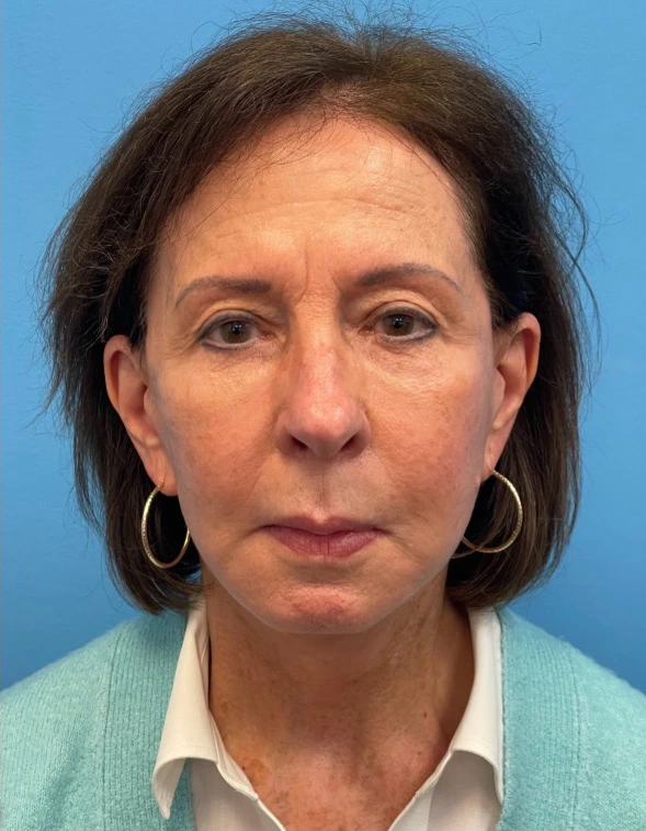 Facelift-Case--25941 | After Dr. Samir Rao 1