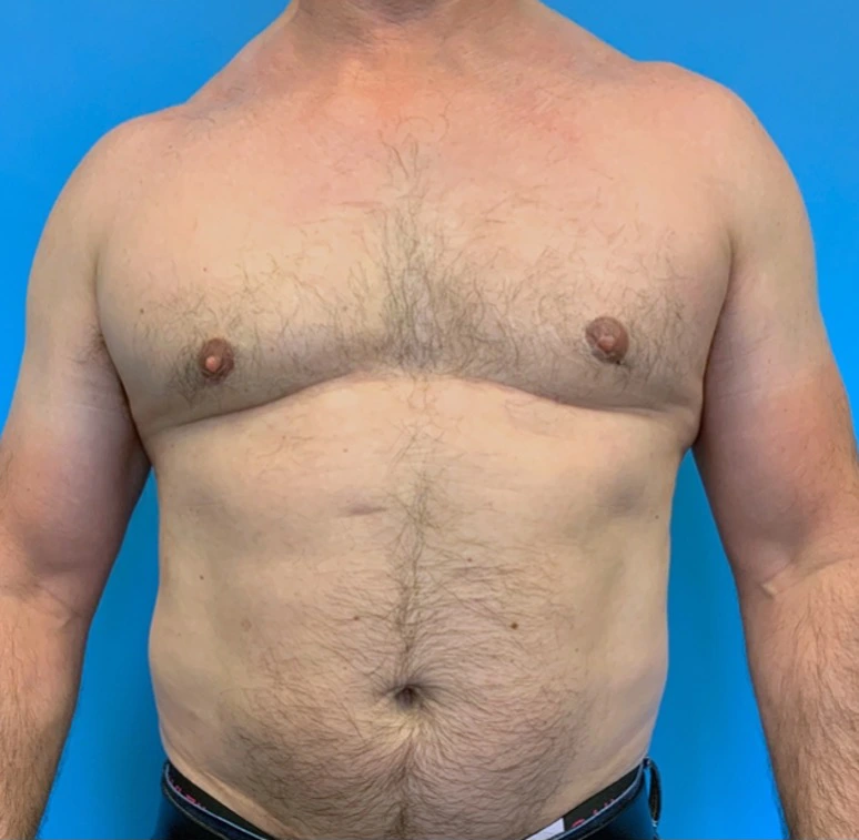 Gynecomastia-Case--20376 | After Dr. Frank Albino 1