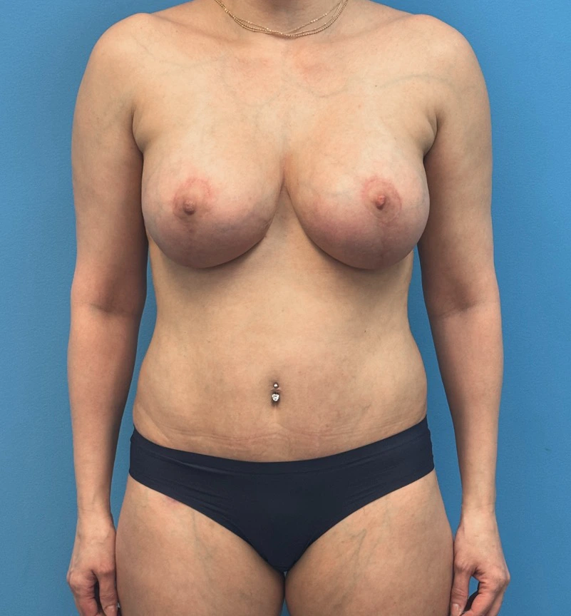 Breast-Augmentation-Tummy-Tuck-Case--28080 | After Dr. Samir Rao 1