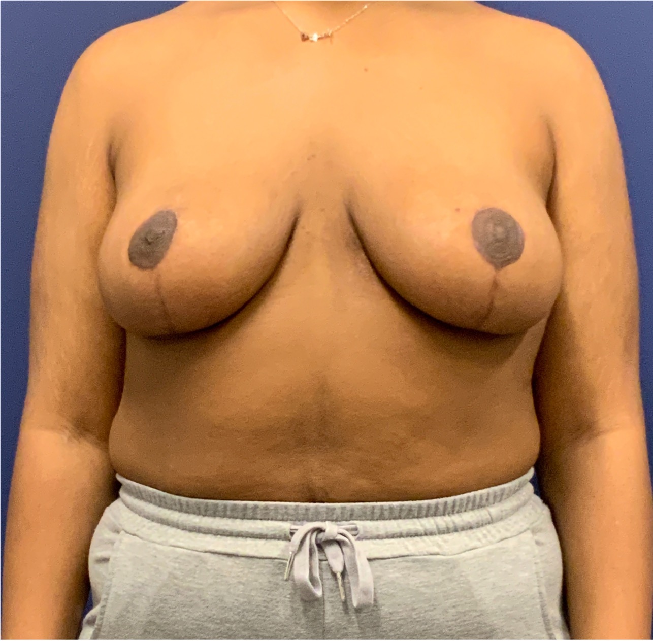 Breast-Reduction-Case--27281 | After Breast Reduction 1